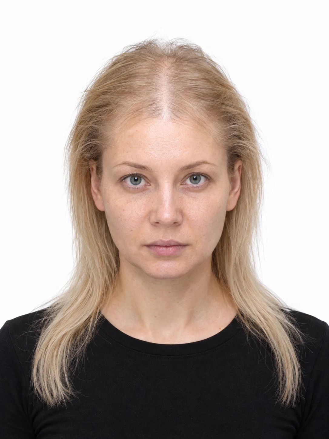 Сейчас: залысины у висков